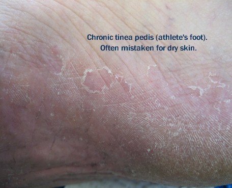 Chronic tinea of the foot